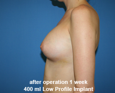 plastic-surgery-breast-augmentation